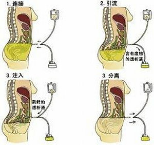 血液透析和腹膜透析的区别