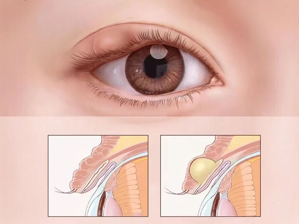 眼科医院健康科普】睑板腺囊肿及睑板腺炎的治疗