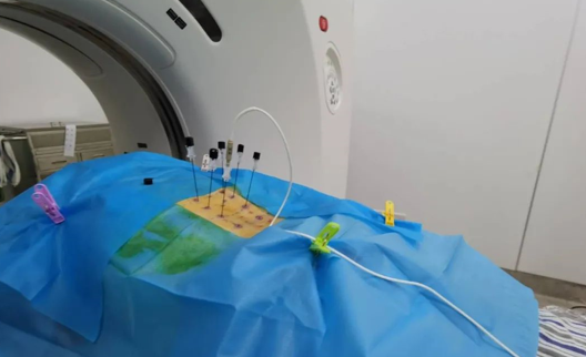 麻醉科实施腰神经后支微创射频术缓解老人的老腰痛