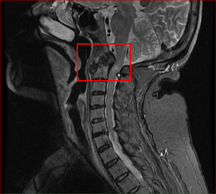 术前颈椎核磁:寰枢椎脱位,颈髓变性,颅底凹陷.png 术前颈椎核磁:寰枢椎脱位,颈髓变性,颅底凹陷.png
