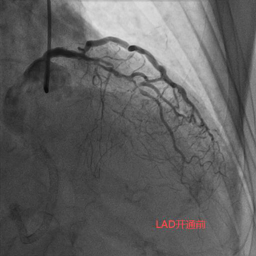 LAD开通前.jpg LAD开通前.jpg