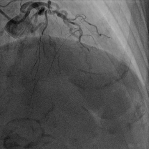 前降支介入术前图像.jpg 前降支介入术前图像.jpg