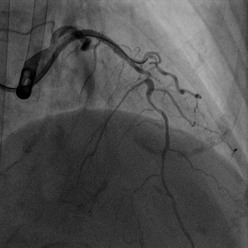 前降支介入术后图像.jpg 前降支介入术后图像.jpg