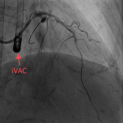 左室辅助装置图像.jpg 左室辅助装置图像.jpg