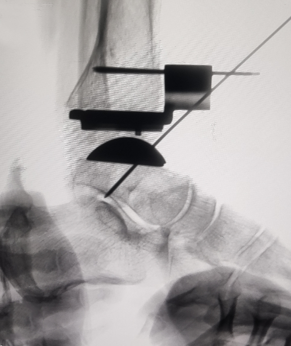 图 3 术中假体位置满意.jpg