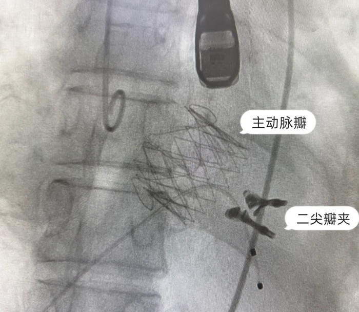 0 术中.jpg 0 术中.jpg