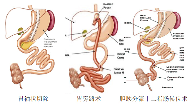 图---现代减重代谢手术 - 副本.jpg