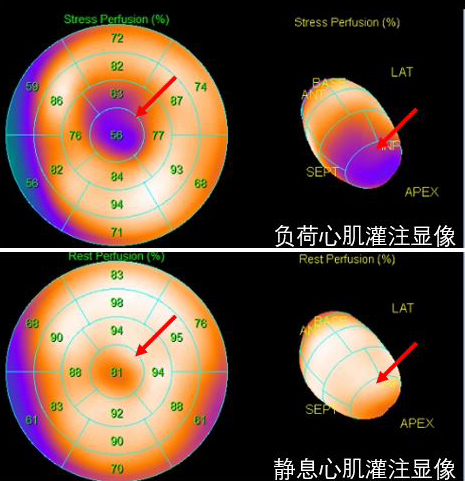 0心肌灌注图.jpg