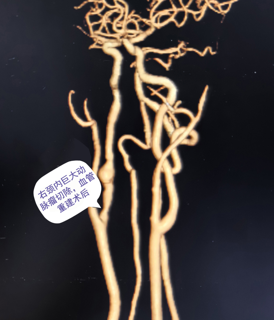 血管重建000.jpg