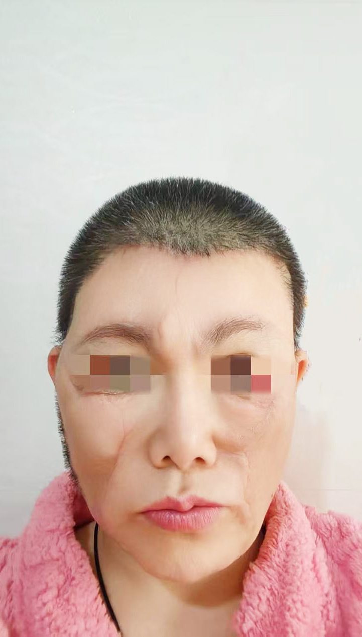 0 治疗后25天.jpg